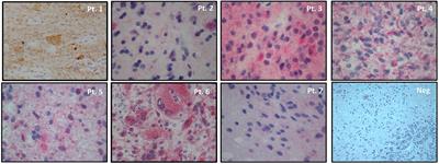 BRAF V600E Inhibitor (Vemurafenib) for BRAF V600E Mutated Low Grade Gliomas